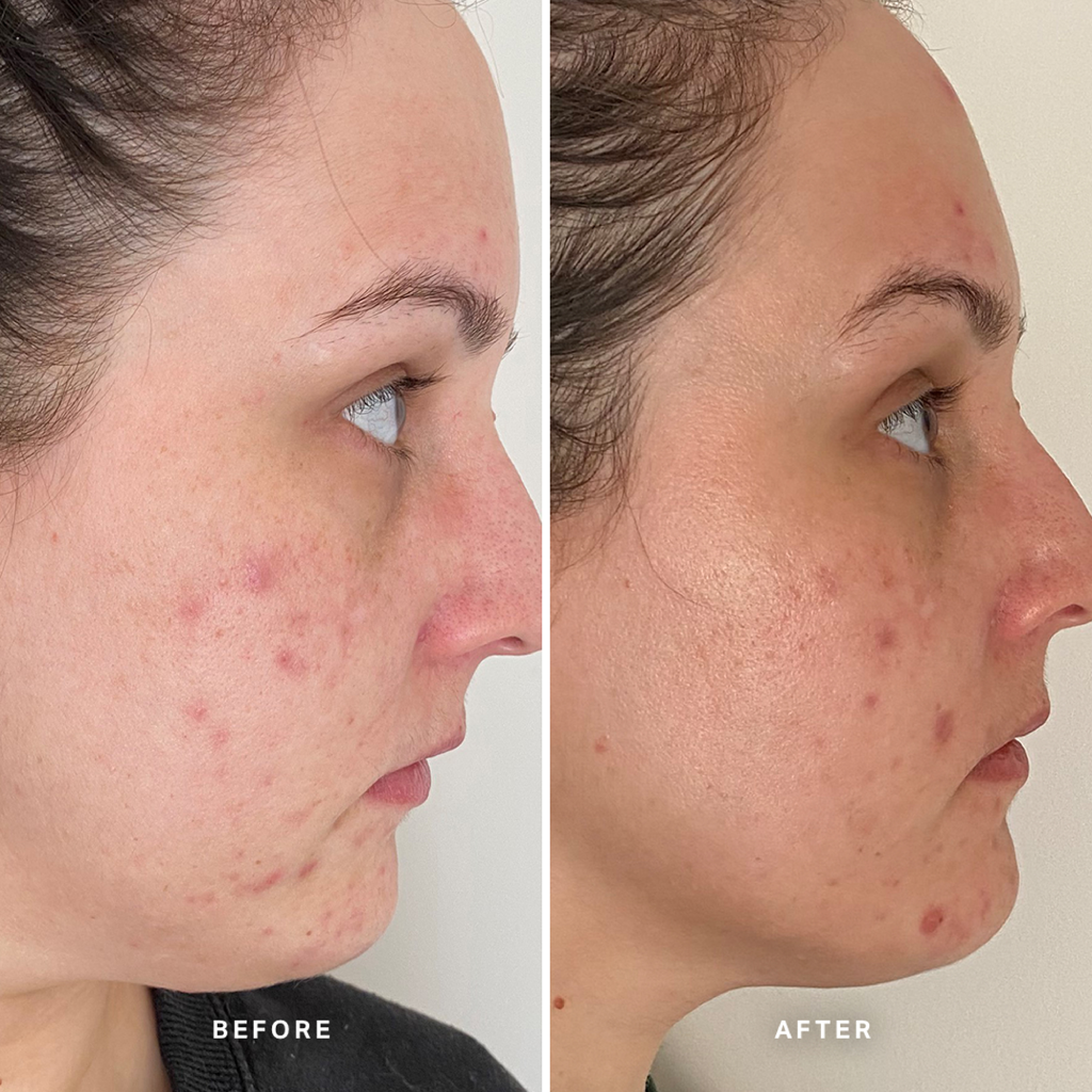 AlphaH Clear Skin Face & Body Wash Gel Cleanser