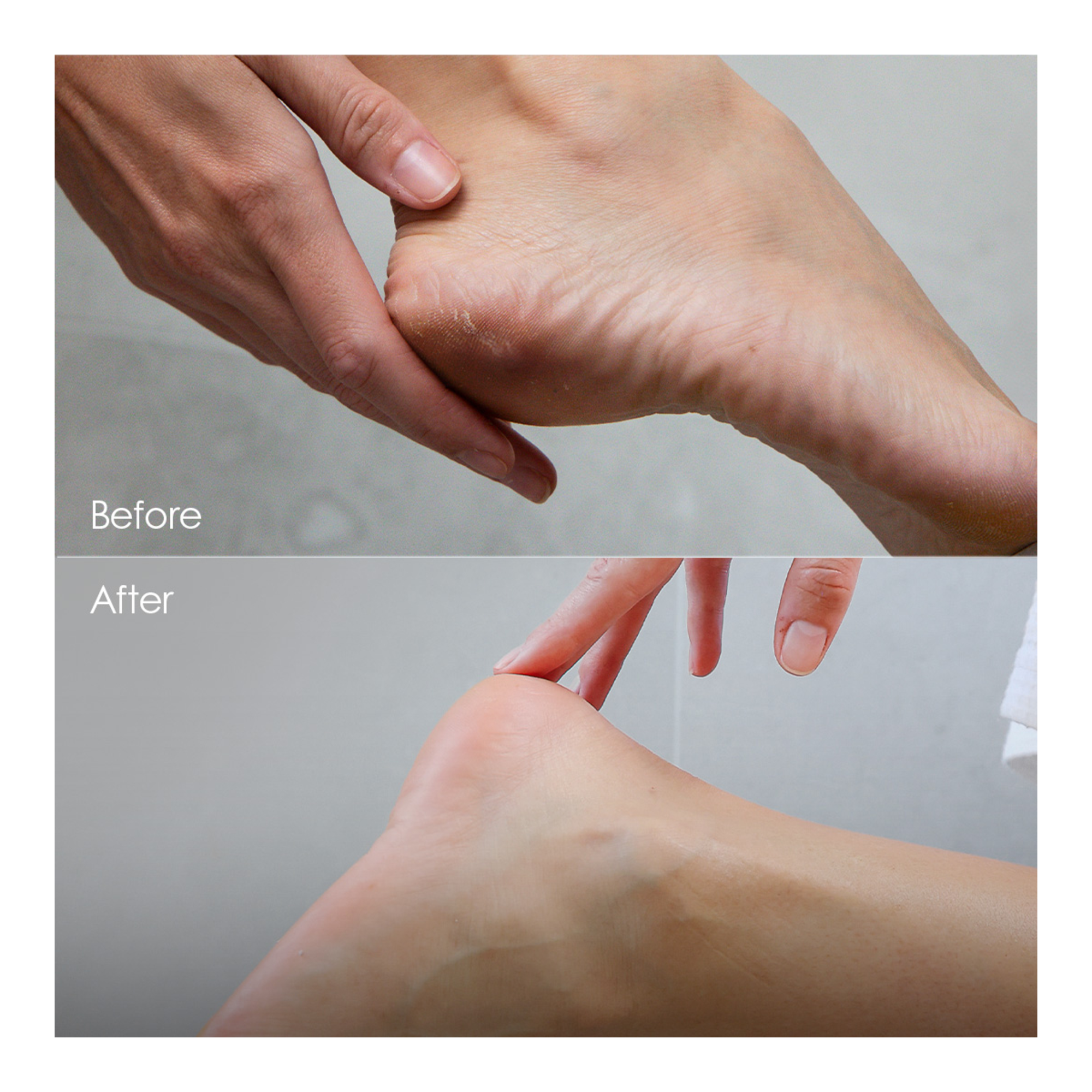 Manicare Callus Remover Foot Razor